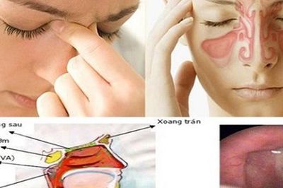 Viêm mũi xoang mùa mưa: Đừng chủ quan với những cơn nghẹt mũi kéo dài