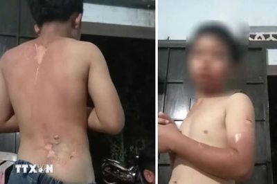 Đắk Lắk: Xác minh thông tin bé trai nghi bị mẹ tạt nước sôi gây bỏng nặng