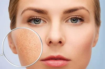 Da mặt bị rỗ có thể cải thiện tại nhà không? Chuyên gia chỉ những cách nên áp dụng