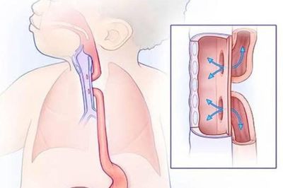 Teo thực quản bẩm sinh cần phát hiện sớm