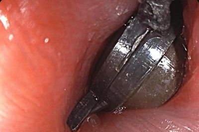 Bé 5 tuổi đau bụng dữ dội, bố mẹ sốc khi bác sĩ gắp ra thứ 'đáng sợ' bên trong