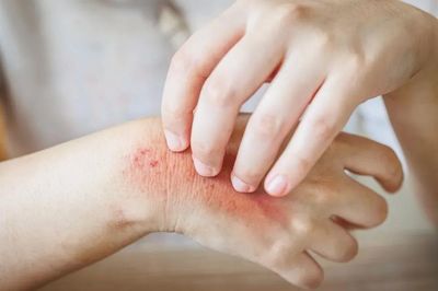 Cách nhận biết và phòng tránh bệnh da thường gặp mùa hè