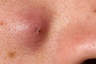 Nguyên nhân gây mụn đinh râu và cách nhận biết sớm để phòng biến chứng