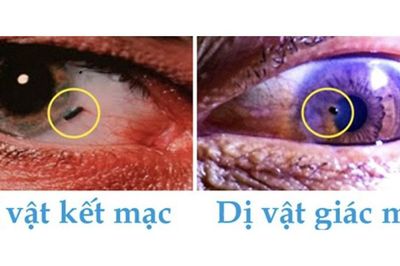 Cảnh báo dị vật mắt khi lao động gây thủng giác mạc