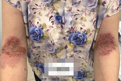 Bệnh da hiếm khiến người phụ nữ lở loét khắp các nếp gấp