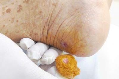 Ngỡ vết thương nhỏ không đáng kể, hai bệnh nhân bất ngờ nguy kịch