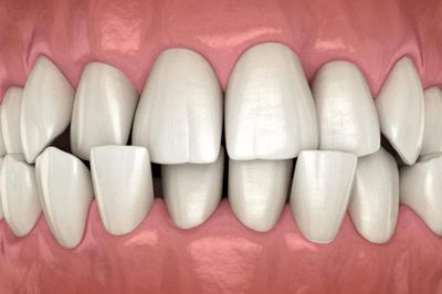 10 dấu hiệu cần chỉnh nha sớm ở trẻ em, đừng đợi đến khi con mọc đủ răng mới đi khám