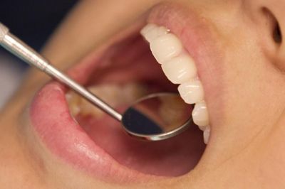 Vi khuẩn thường gặp trong miệng có thể là 'thủ phạm' âm thầm gây hẹp van tim?