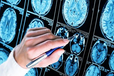 Giới y học sửng sốt phát hiện chàng trai 19 tuổi mắc Alzheimer