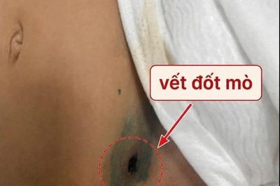 Sốt 5 ngày, bé gái 2 tuổi thoát khỏi sốc nhiễm khuẩn nhờ phát hiện vết đốt mò