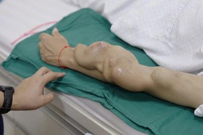 Cảnh báo biến dạng cánh tay nghiêm trọng do chạy thận nhân tạo