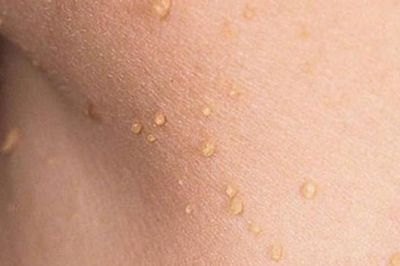 Vì sao mụn thịt thường mọc quanh mắt, xử trí thế nào?