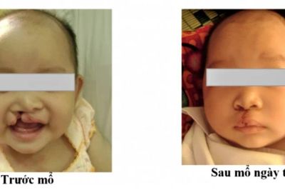 Nghệ An tiếp nhận viện trợ chăm sóc trẻ em bị dị tật khe hở môi, vòm miệng