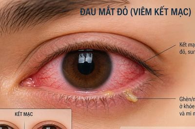 Bệnh đau mắt đỏ gia tăng, Bộ Y tế cảnh báo 7 điều tuyệt đối không được chủ quan