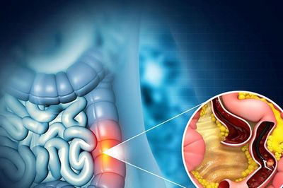 Đừng để ung thư trở thành 'hệ lụy dòng họ' từ hội chứng Lynch