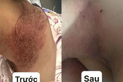 Khổ sở quấn khăn quanh người nhiều năm vì căn bệnh da liễu hiếm gặp