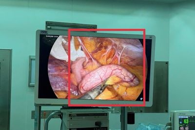 Đau bụng nhẹ hai ngày, nhập viện bác sĩ phát hiện ruột thừa viêm nặng