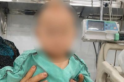 Cứu sống bé gái 7 tháng tuổi ngừng tim, ngừng thở do hóc quả chôm chôm