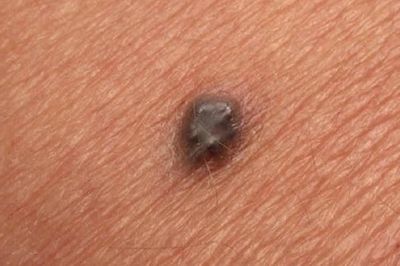 Người đàn ông 69 tuổi nguy kịch từ nốt ruồi 'lạ', bác sĩ chỉ mặt điểm tên dấu hiệu 'chí mạng' nhiều người bỏ qua