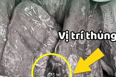 Chủ quan trước cơn đau bụng, người đàn ông bất ngờ phát hiện ung thư hiếm gặp