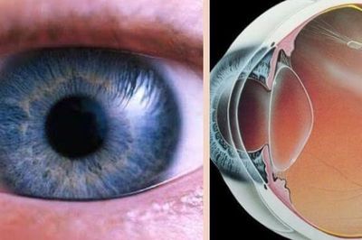 Mắt nhìn xa bị nhòe là biểu hiện của bệnh gì?