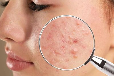 Da dầu mãi không hết mụn? Có thể bạn đang lặp lại 4 thói quen này mỗi ngày