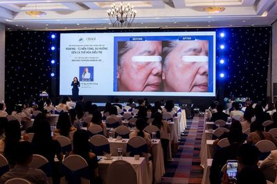 Rám má không còn là bệnh lý thẩm mỹ đơn thuần