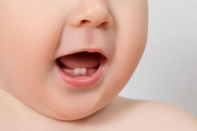 Dính thắng lưỡi ở trẻ em