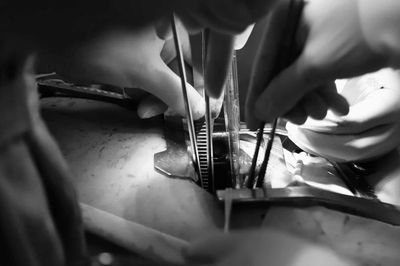 Tạo hình phế quản cho bệnh nhân ung thư phổi
