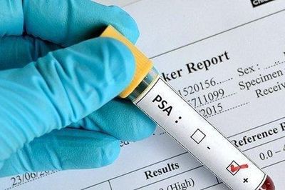 Nam giới từ 40 tuổi cần làm một xét nghiệm để sàng lọc ung thư tuyến tiền liệt