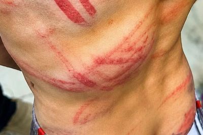 Bé trai 9 tuổi nhập viện với nhiều vết thương do bố đẻ bạo hành