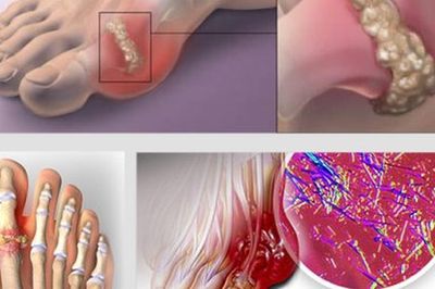 Bị bệnh gout có nên ăn cá?