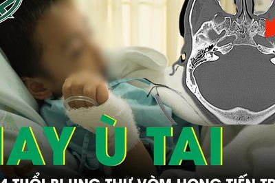 Bé trai 14 tuổi liên tục ù tai, bác sĩ phát hiện ung thư vòm mũi họng giai đoạn tiến triển