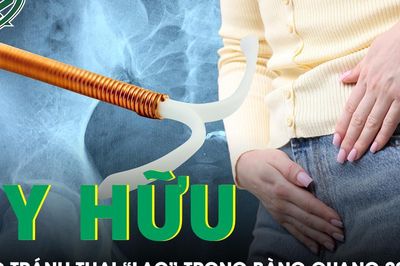 Vòng tránh thai 'mất tích' 29 năm bất ngờ được tìm thấy trong bàng quang