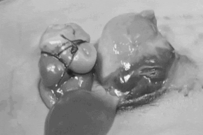 Em bé chào đời với một phần trái tim nằm ngoài cơ thể