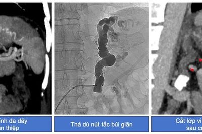 Nút tắc tĩnh mạch cứu bệnh nhân xuất huyết dạ dày
