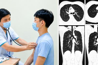 Nam thanh niên 20 tuổi tràn khí trung thất sau 1 tuần ho liên tục, bác sĩ cảnh báo dấu hiệu dễ bị bỏ qua