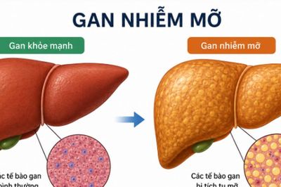 Cách chữa gan nhiễm mỡ độ 1 không dùng thuốc