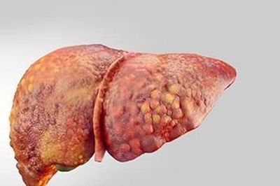 Xuất hiện 4 dấu hiệu kéo dài, người phụ nữ được chẩn đoán xơ gan