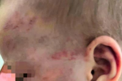 Điều tra vụ bé trai 3 tuổi bị cha dượng đánh chấn động não