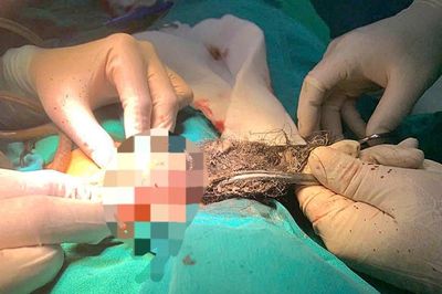 Búi tóc dài gần 20cm trong dạ dày bé trai 46 tháng tuổi