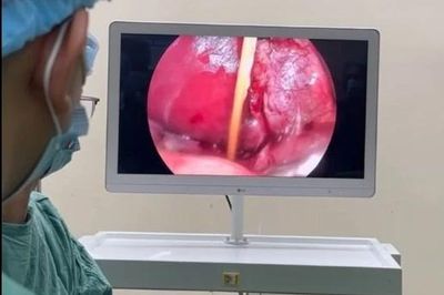 Sau 3 tuần nuốt tăm tre, bé trai 8 tuổi bị dị vật đâm xuyên tá tràng vào gan