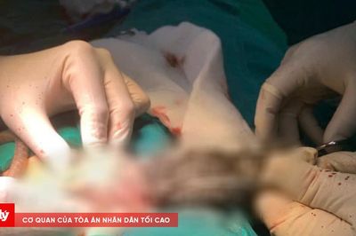 Phẫu thuật lấy búi tóc dài gần 20cm trong dạ dày bé trai
