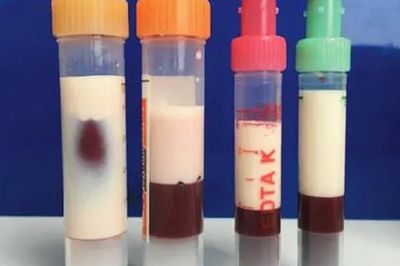 Bé trai 5 tuổi máu 'trắng đục như sữa' vì thường xuyên ăn món canh quen thuộc