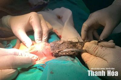 Phẫu thuật thành công cho bệnh nhi mắc hội chứng Pica