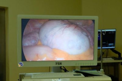 Cô gái 26 tuổi phát hiện u buồng trứng kích thước 15cm từ dấu hiệu nhiều người Việt dễ bỏ qua