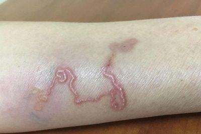 Nhóm người tuyệt đối không được quên tẩy giun