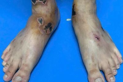 Điều trị thành công ca bệnh viêm mạch hiếm gặp