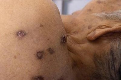Cụ ông 98 tuổi bị ong vò vẽ đốt gần 80 nốt khi đang làm vườn