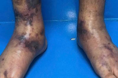 Chẩn đoán và điều trị thành công trường hợp mắc bệnh viêm mạch hiếm gặp